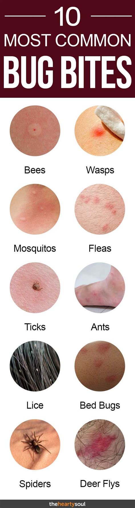 Different Bug Bites Chart