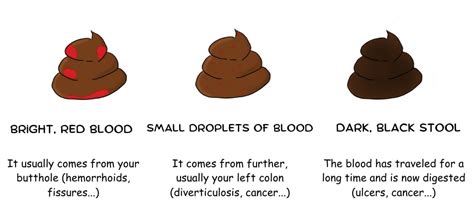 Different types of blood in stool