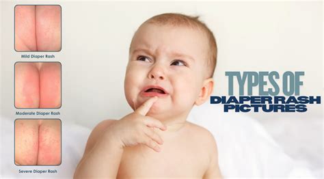 Different types of diaper rash. .  ...
