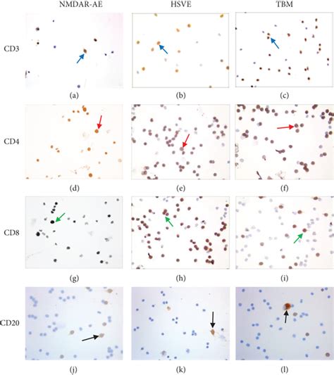 Differential Diagnosis of Autoimmune Encephalitis from ... - Hindawi