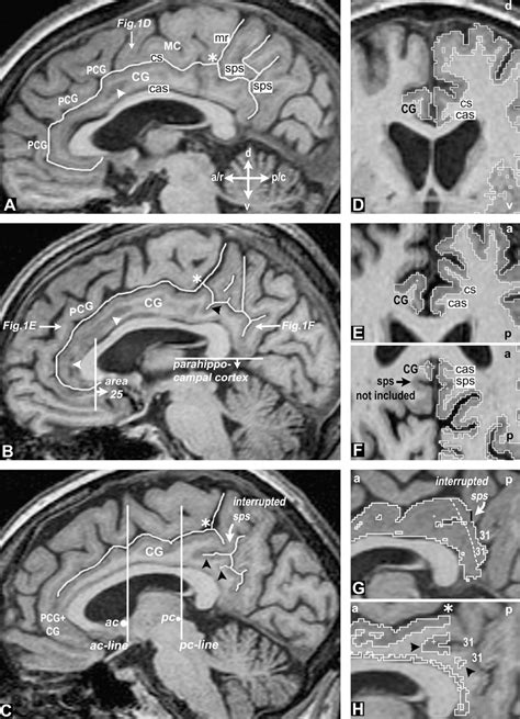 Differential Regional Atrophy of the Cingulate Gyrus in Alzheimer ...