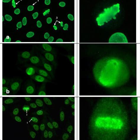 Differentiation of ANA patterns on HEp2 cells that share a diffuse