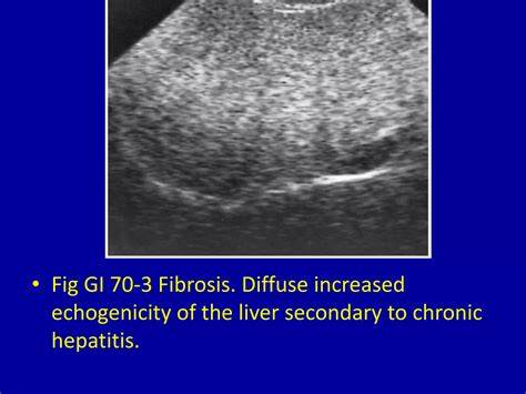Diffuse increased echogenicity of the liver.  Learn what increased echogenicity means, ...