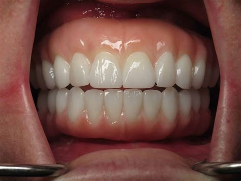 Digital Dentistry, Implant, Crown and Bridge, Zirconia, Sydney