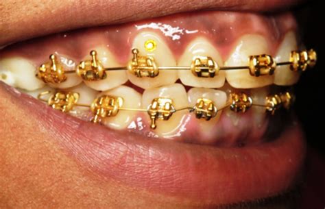 Dimond braces. Things To Know About Dimond braces. 