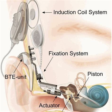 Direct acoustic cochlear implant - Wikipedia