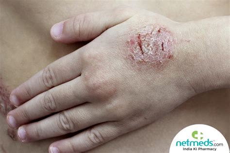 Discoid Eczema Causes and Treatment Patient