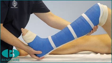 Discover the Patella Tendon Bearing Cast: Ultimate Guide for Enhanced Healing