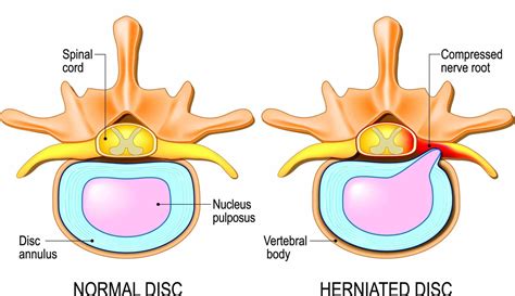 Find out about the role of discs in the spine, their functions, frequent conditions and treatment options for a healthy and painless back.