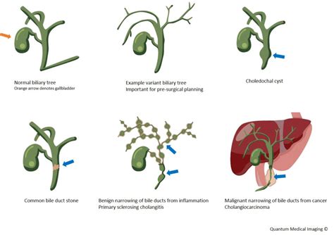 Disease of the Gallbladder and Biliary Tree - Diseases of the …