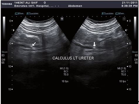 Disintegration of renal and ureteral calculi with ultrasound