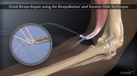 Distal biceps endobutton.  Using a titanium BicepsButton implant, this technique reliab...