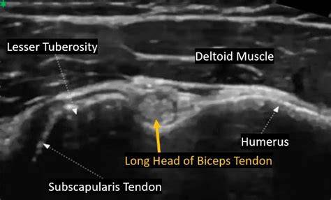 Distal biceps tendon insertion ultrasound.  Objectives: Muscles and their tendons prese...