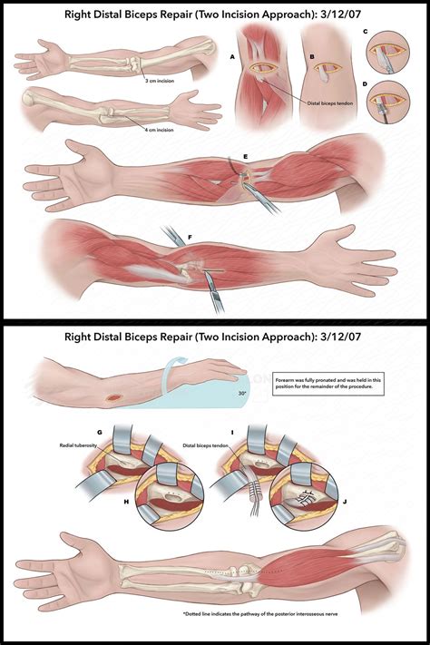 Distal biceps tendon repair anesthesia.  Length of Stay This is same-day Th...