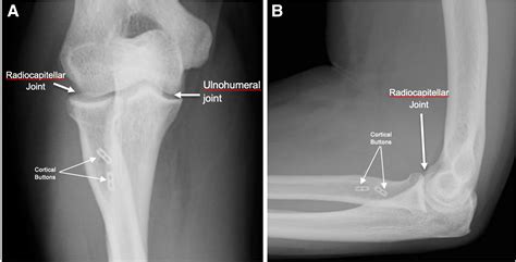 Distal biceps unicortical button.  The described.  anatomic xation of th...