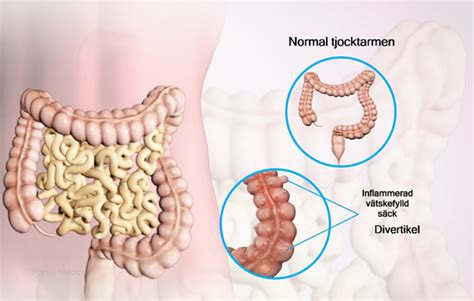 Divertikulit alkohol