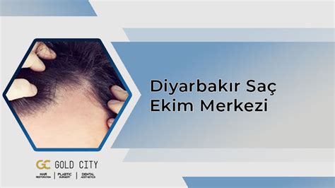 Diyarbakır saç ekimi merkezi