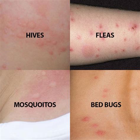 Do Bed Bugs Bite in the Same Spot? (Important Facts)