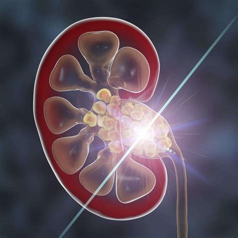 Do Kidney Stones Affect Sperm