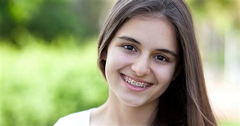 Do You Have to Pay for NHS Braces? Splash Orthodontics