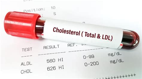 Do You Need To Fast Before A Cholesterol Test