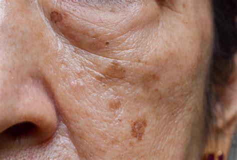 Do age spots appear suddenly? - TimesMojo