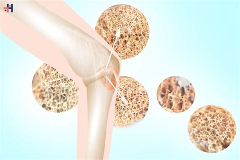 Do bones melt.  Bone density and size also affect how quickly bone changes,...