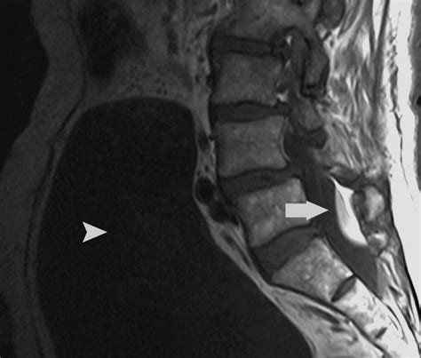 Do cranial subdural hematomas migrate to the lumbar spine?