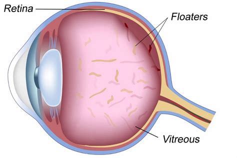 Do floaters in the eye ever go away? - Eye Floaters