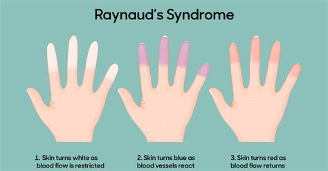 Do i have raynauds quiz.  &hellip; 1.  The sciatic nerve travels from the butt...