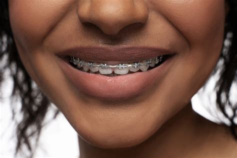 Alabama Medicaid does not cover orthodonti