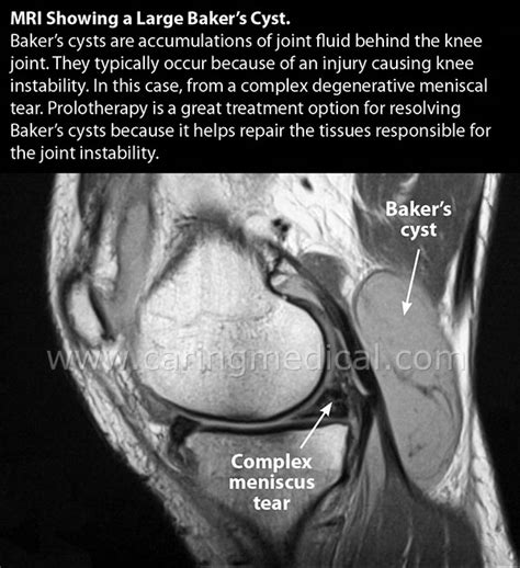 Doctor K: Baker’s cysts often recur after draining