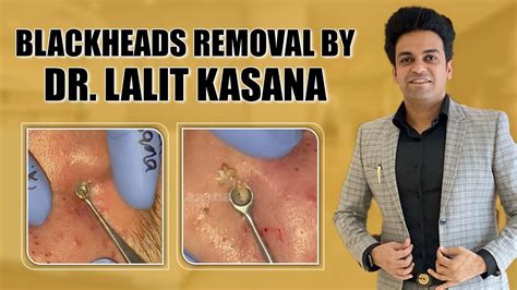 big pimple and blackhead popping by dr.lalit kasana (21may 2019)please like and share .. and dont forget to subscribe my channel... love you all... 