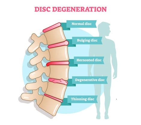 Doctors for Disc Degeneration In Okara Marham