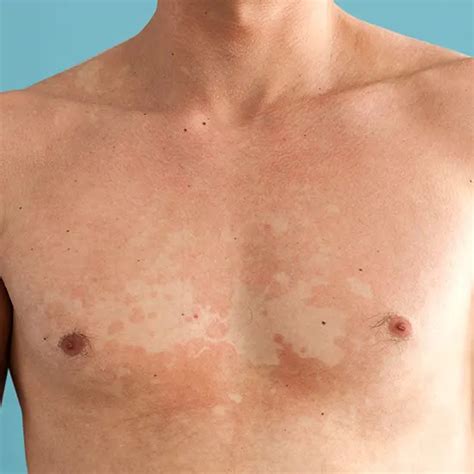 Doctors for Tinea Versicolor in Punjabi Bagh, Delhi