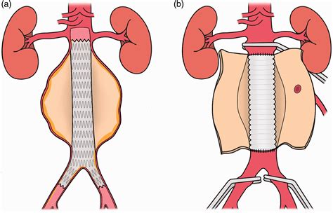 Doctors who perform Aortic Aneurysm Repair near Madison, WI