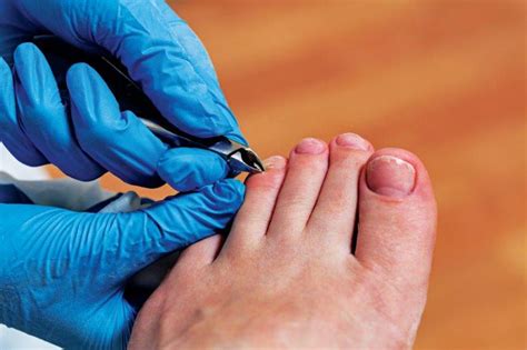 Documentation for toenail trimming - AAPC