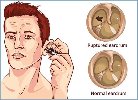 Does An Eardrum Repair Itself - BikeHike