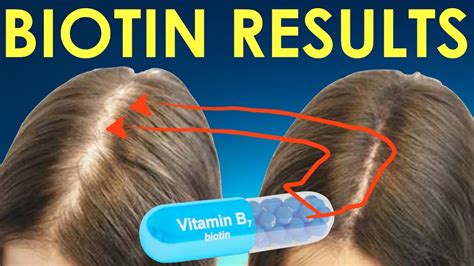 Does Biotin help Hair Growth? Results, Before After Pictures, …