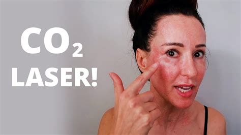 Does CO2 laser tighten skin? - YouTube