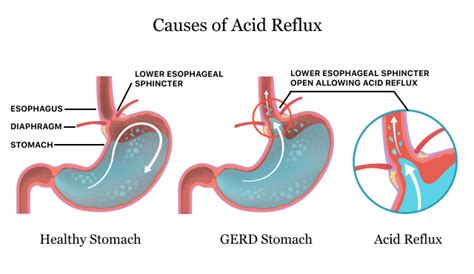 Does GERD cause tingling? – Healthy Bite Guide