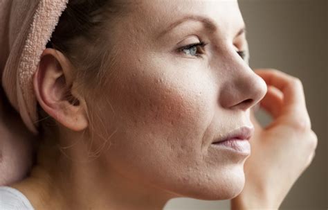 Does IPL Skin Rejuvenation Help Get Rid of Acne Scars?