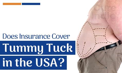 Does Insurance Ever Cover a Tummy Tuck? Michael J.