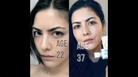 Does Retin-A (Tretinoin) Delay Skin Aging? 15 Year Review