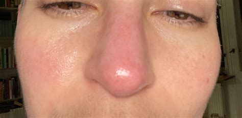 Does Your Nose Appear Large and Red? You May Have Rosacea