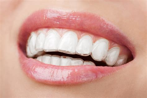 There are ways to speed up tooth movement. Ask your Invisalign provider if they offer AcceleDent or Propel, devices that stimulate the bone and roots to deliver 50–70% faster results. Another benefit: they can also reduce discomfort as your teeth move. The only downside is the cost: AcceleDent is expensive, and insurance doesn’t cover it.