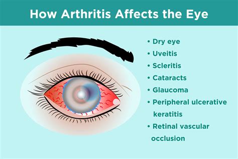 Does arthritis affect the eyes What you need to know