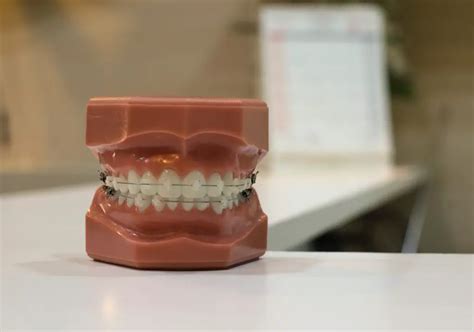 Does chip cover braces. Things To Know About Does chip cover braces. 