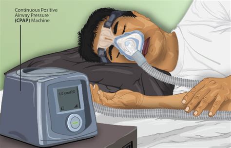Does cpap qualify for sce medical baseline. 