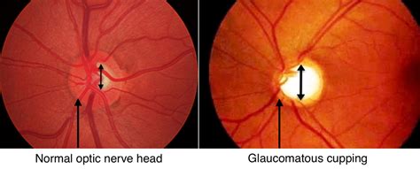 Does enlarged optic nerve mean glaucoma? – …